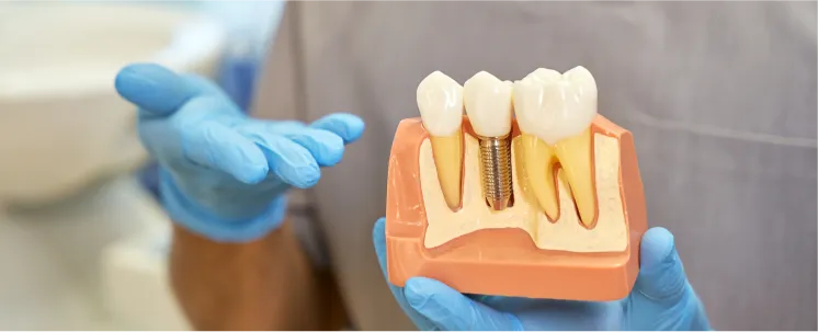 Restore Your Smile With Our Quality Tooth Implants in Philadelphia