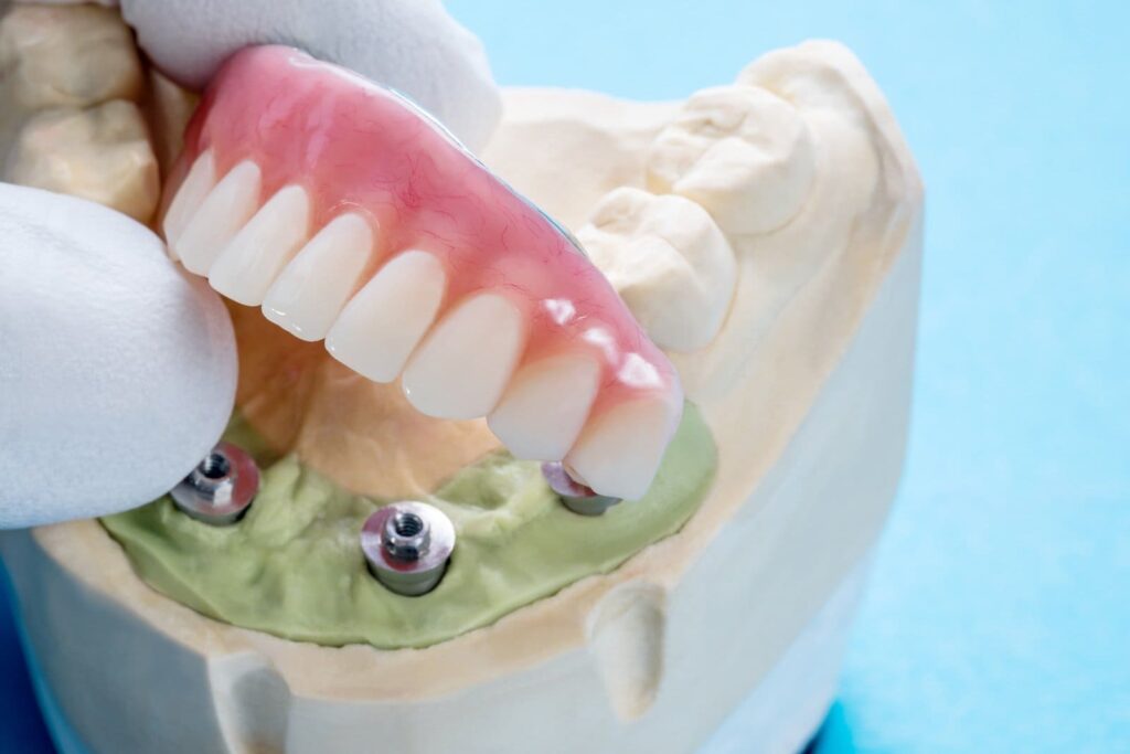 All-on-4 Dental Implants