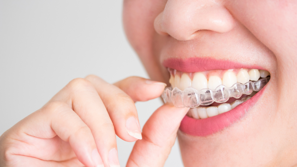 Invisalign in Southampton